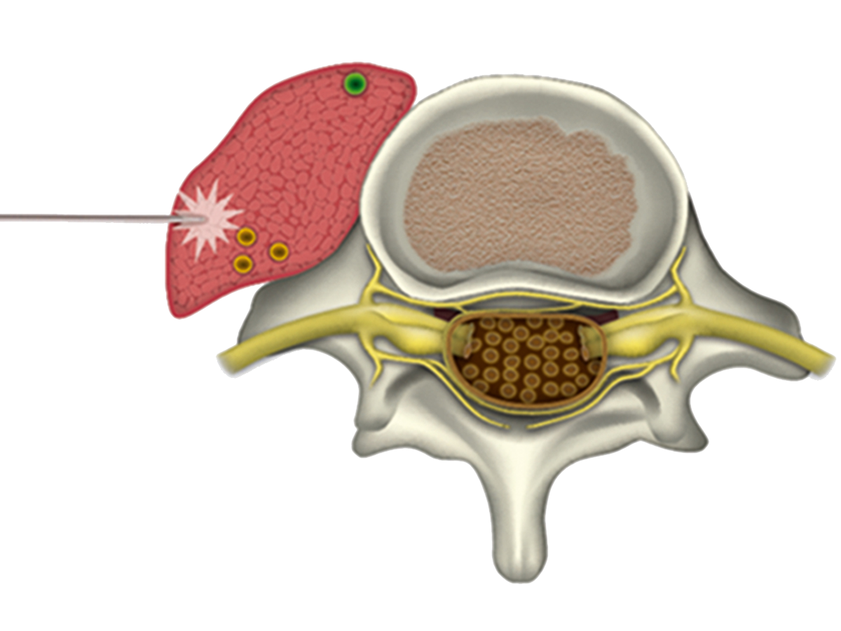 Illustration: vertebra with muscle